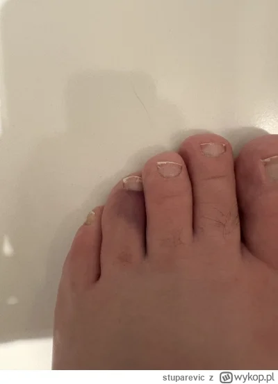 stuparevic - Uderzyłem się dzisiaj o próg drzwi. Grozi amputacją palca? #kiciochpyta ...