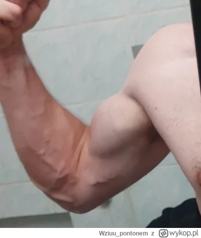 Wziuupontonem - @Wziuupontonem: może to żylaki