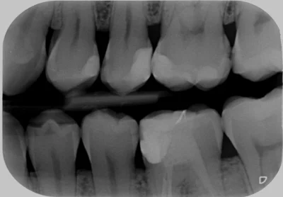 Zapaczony - Poszukuję dentysty w #poznan #lubon do wyrwania jednej dziurawej ósemki i...