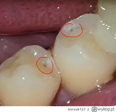 borsuk123 - #stomatologia 
Czy takie ciemne artefakty na zębach to zawsze próchnica? ...