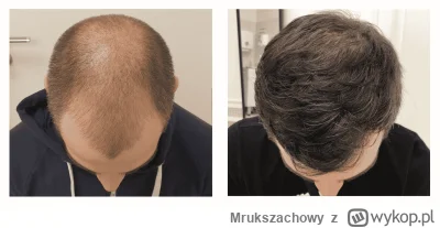 Mrukszachowy - Przeszczep włosów w Turcji FAQ

Lecimy z kilkoma chłopakami z wykopu n...