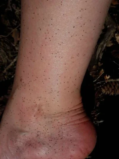 dr00 - >chyba fantazja Cię poniosła z tymi gniazdami kleszczy i setkami nimf xd

@Kek...