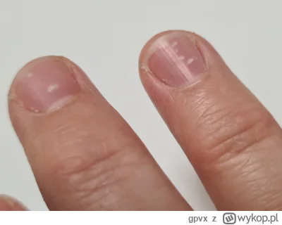 gpvx - Takie kropki zaczęły mi się pojawiać na paznokciach - co to może być ?
Najpier...