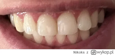 Nikoks - Hej czy nadwrażliwość zębów po bondingu to coś normalnego? Jedynki były dosy...