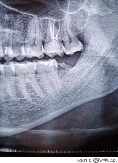 Koichi - Ta... 700zł za usunięcie zęba + recepta na antybiotyk.
Tak panie doktorze, p...