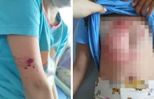 Siedmiolatka pogryziona przez psa. Zwierzę wyszło ze schroniska z opiekunem...