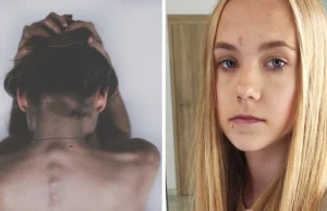 Nastolatka z Jastrzębia-Zdroju umiera z głodu! Walczy z anoreksją bulimiczną