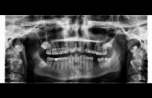 Czy leczony kanałowo ząb zatruwa organizm, dlatego że jest martwy?