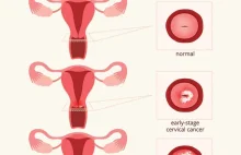 Cervical cancer Symptoms and causes