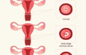 Cervical cancer Symptoms and causes