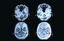 Absolutny przełom w leczeniu choroby Huntingtona