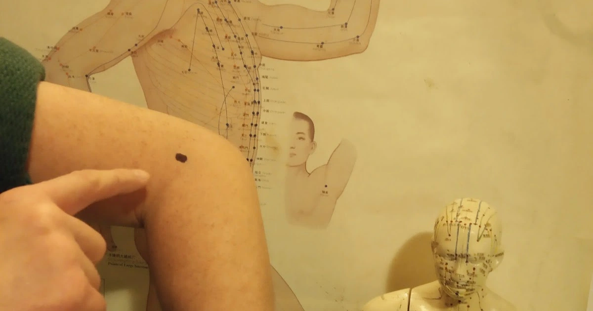 Jak Wspomóc naturalnie Leczenie Nadciśnienia. Punkt Qu Chi na Nadciśnienie!