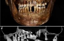 Złoty sekret dentystyczny francuskiego arystokraty ujawniony po 400 latach.
