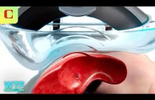 Niszczenie guzów za pomocą DŹWIĘKU: Demonstracja nowej technologii