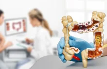 Co 4. pacjent badany w profilaktyce raka jelita grubego ma zmiany przedrakowe