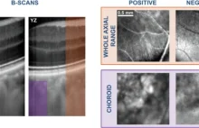 Nowy sposób monitorowania mikrokrążenia oka