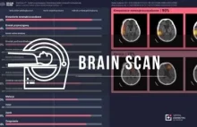 Sztuczna inteligencja BrainScan pomoże radiologom z pszczyńskiego szpitala