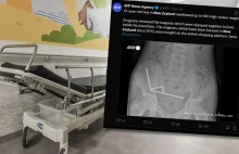 100 magnesów neodymowych połączyło się w jelitach 13-latka, który je połknął.