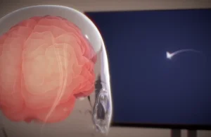 Neuralink w głowie pierwszego człowieka. Elon Musk przechodzi do historii