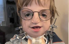 Chirurdzy odbudowali szczękę 7-letniego chłopca z jego własnych żeber