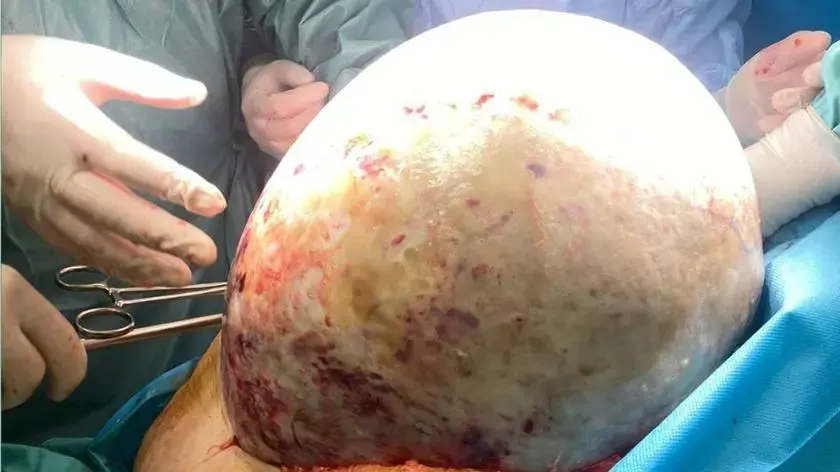 20 kilogramowy guz jajnika u 68 letniej pacjentki wycięty w Elblągu.