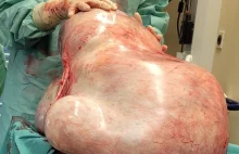 32-kilogramowy guz w brzuchu młodej kobiety