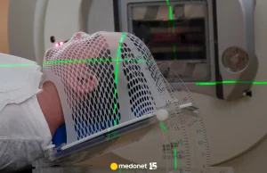 Mamy pierwszy lek na glejaka. Onkolog: to przełom