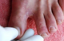 Problem, o którym mało się mówi. Co roku choruje ponad 100 tys. Polaków