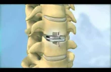 Jak wygląda wymiana dysku na implant w kręgosłupie? Przednia discektomia szyjna.