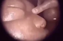 Wygląd płodu podczas fetoskopii