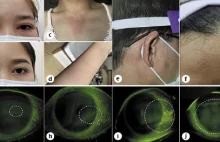 Silne podrażnienie oczu i wysypki po kontakcie z odparowaną szczepionką covid