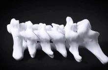 Modelowanie 3D skoliozy oferuje nieinwazyjne możliwości diagnostyczne