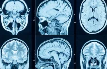 Naukowiec bada, jak odkliknąć w mózgu PTSD