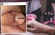 Plamka na paznokciu okazała się złośliwym nowotworem