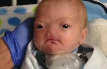 Facebook usunął zdjęcie chłopca, który urodził się bez nosa.