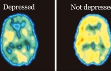 Nowe badanie wyjaśnia, że depresja to nie wybór, a forma uszkodzenia mózgu
