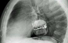40 lat temu wszczepiono pacjentowi pierwszy defibrylator.
