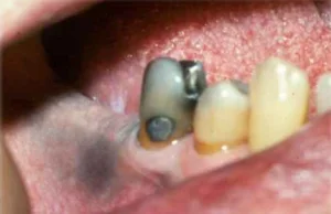 NFZ obcina stomatologię - pacjenci tracą zęby