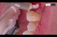 Ceramiczny implant zęba