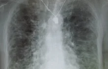 Koronawirus poważnie niszczy odporność i trwale uszkadza płuca