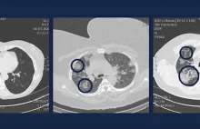 Belgijski lekarz pokazał skany płuc młodych ludzi zakażonych koronawirusem