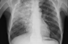 Nawet bezobjawowy przebieg choroby może powodować zmiany w płucach.