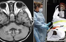 Koronawirus: Odkryto niebezpieczne obrzęki mózgu u zarażonych