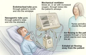 Większość osób pod respiratorem z Covid-19 umiera.