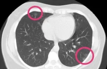 Radiolodzy: COVID-19 nawet bez objawów może wywoływać zmiany w płucach