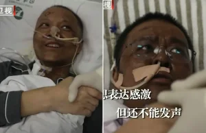 Skóra chińskich doktorów pociemniała po wyleczeniu z koronawirusa [Ang]