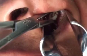 Dość nietypowe miejsce jak na usuwanie zęba ( ͡° ͜ʖ ͡°)