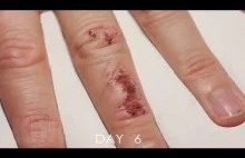 Gojenie się uszkodzonej skóry na palcu
