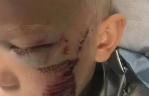 6-latek uratował siostrę przed atakiem psa. Zwierzę rozszarpało mu twarz