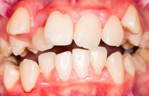 Wciąż nieznane są skutki leczenia ortodontycznego